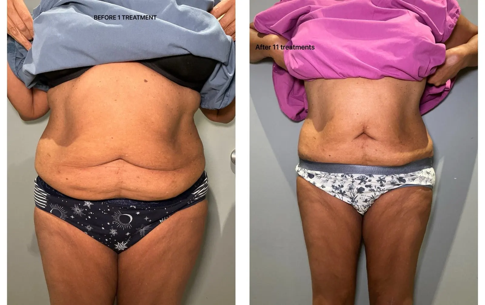 Before and after T-Shape 2: stomach, after 11 treatments