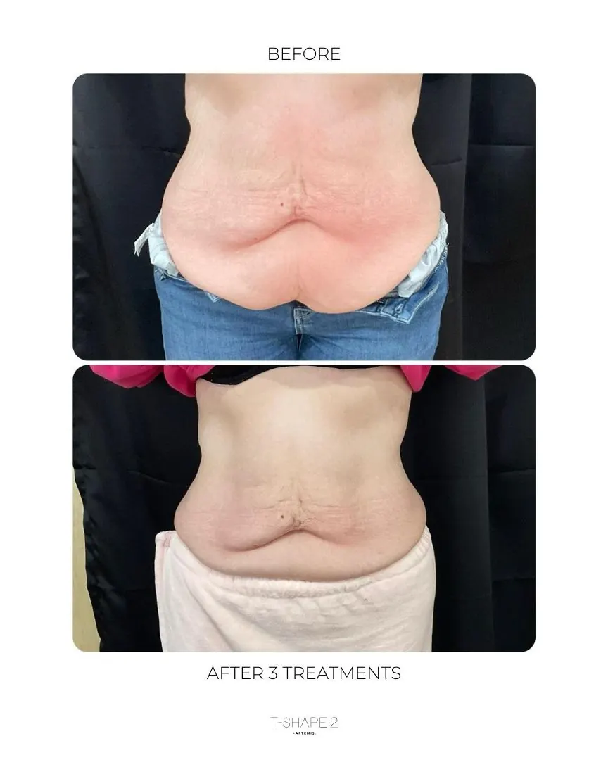 Before and after T-Shape 2: loose skin on the stomach after weight loss, after 3 treatments