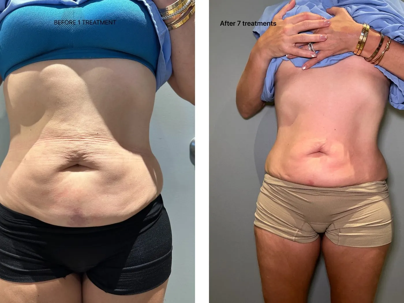 Before and after T-Shape 2: loose skin on the stomach, after 7 treatments